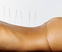 Acupuncture for Low Back Pain