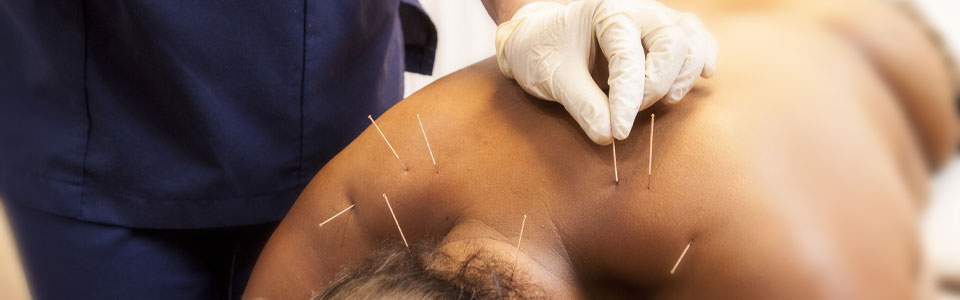 Dry Needling Dry Needling